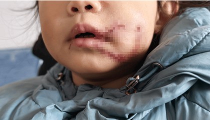 网曝巴中1岁10个月女童被狗咬伤脸部 父亲：已报警，将寻找狗主人追责到底