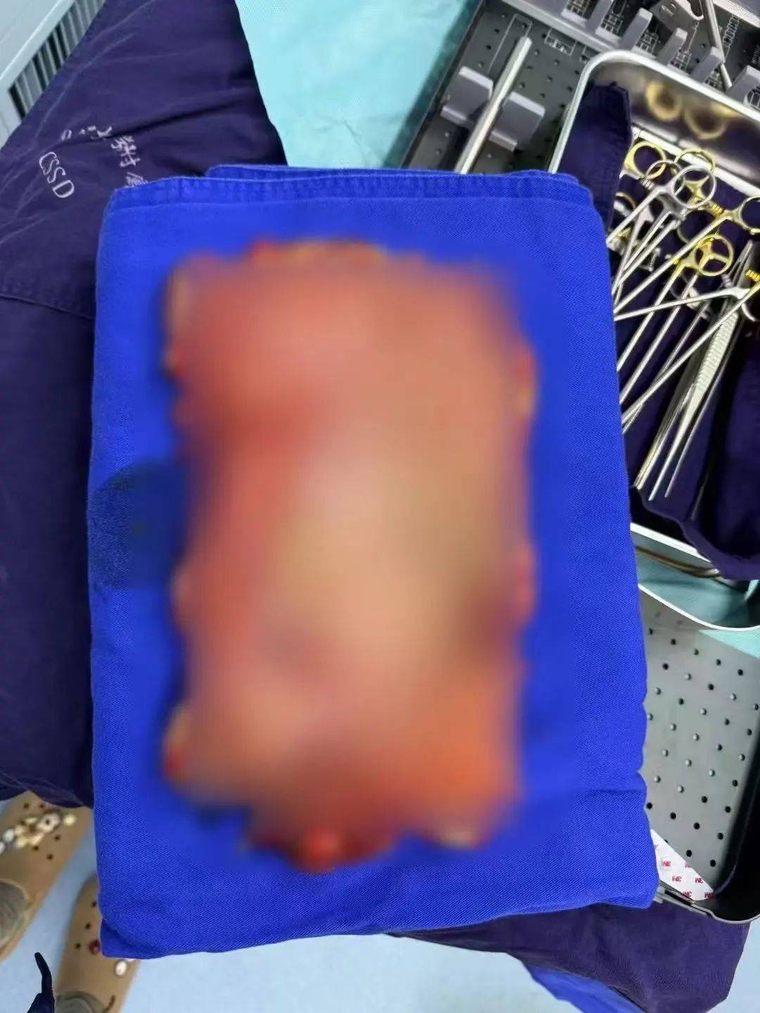 女子多器官衰竭、整个胃被摘除,医生清理出10斤……紧急提醒