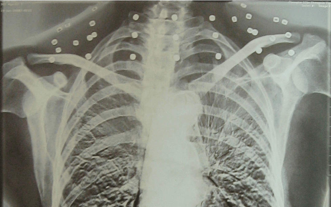 “老先生,您把项链取下来再做CT”